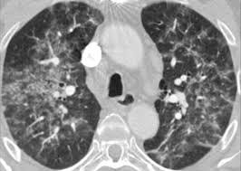 pneumonitis