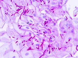 Aspergillomycosis